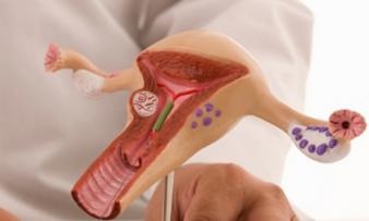 Iomul uterului pe fondul endometriozei interne Ce este?