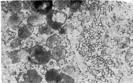 Diagnosticul morfologic - boala ulcerului peptic