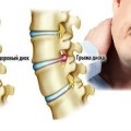 Tratamentul popular al coloanei vertebrale herniate