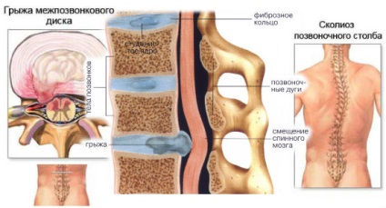 Tratamentul popular al coloanei vertebrale herniate