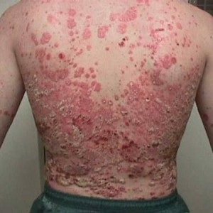 În ceea ce privește psoriazisul este periculos, complicațiile psoriazisului pentru leacul complet pentru psoriazis este elita cosmetică