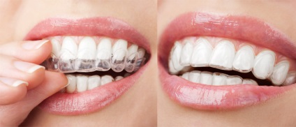 Invisalign braces invisalign la Moscova, tratament, cost și instalare, stomatologie non-stop