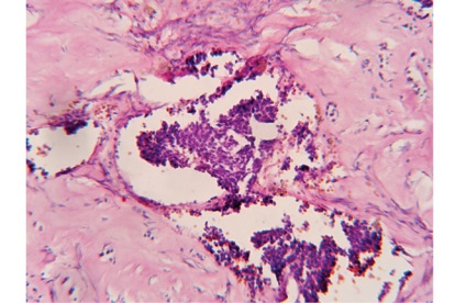 Nonchromafină paraglion mediastinum, oncologie clinică