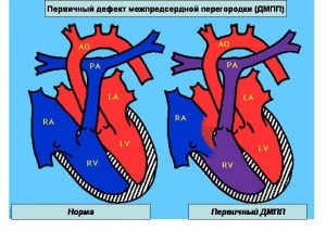 Fie că este necesar să închideți dmnp, kardiopapa - totul despre bolile inimii copiilor