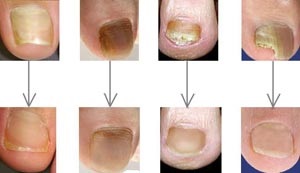 Onychomycosis (ciuperca unghiilor) tratament