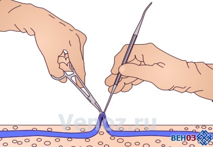 Chirurgie pentru venele varicoase