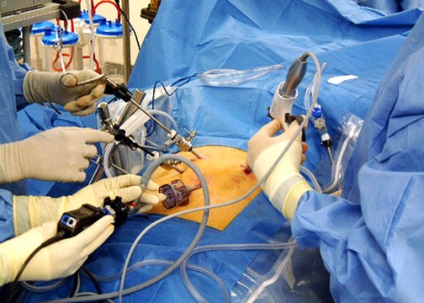 Fundoplicarea operației cu esofagită de reflux - medglobus medlobus