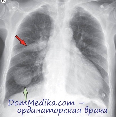 Afecțiuni asemănătoare bolilor parenchimului pulmonar