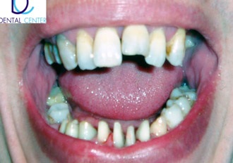 Ortodonția în Tver, alinierea mușcăturii dinților