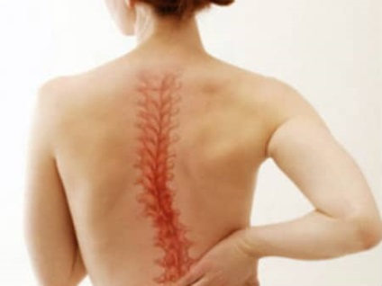 Osteochondrosis fotografii ale manifestărilor bolii în cervical, toracic și lombar