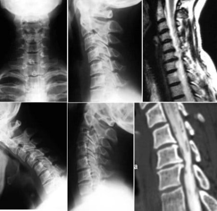 Osteochondrosis fotografii ale manifestărilor bolii în cervical, toracic și lombar