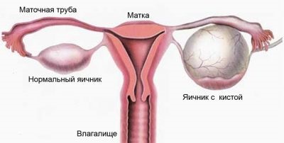 Tratamentul chisturilor ovariene parovariale fără intervenție chirurgicală