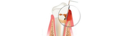 Recepționarea parodontală