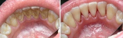 Parodontoza dinților - tratamentul remediilor populare tratate cu metode populare (fotografie), la nivel național
