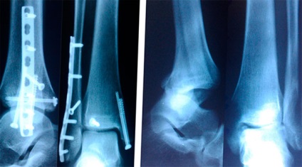 глезена фрактура с изместване на видовете, рехабилитация и последствия