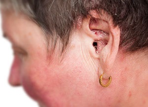 De ce există psoriazis în urechi