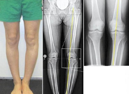 Poliartrita articulației genunchiului și a umărului - simptome și tratament