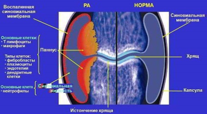 Poliartrita articulației genunchiului și a umărului - simptome și tratament