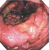 Polyp din cecum (cupola) - simptome și tratament