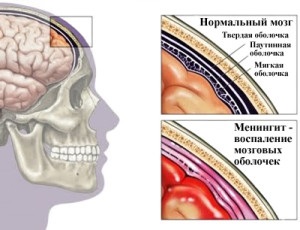 Consecințele meningitei la copii și adulți