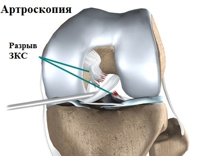 A posterior cruciate ligament sérülése és törése