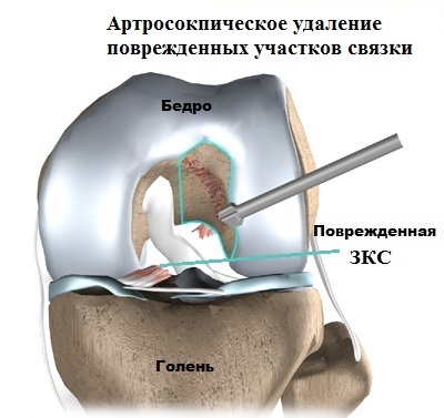 Daune și rupturi ale ligamentului posterior al crucii