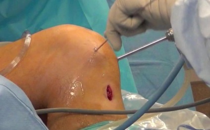 A posterior cruciate ligament sérülése és törése