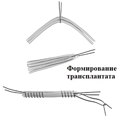 A posterior cruciate ligament sérülése és törése