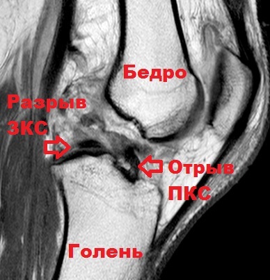 A posterior cruciate ligament sérülése és törése