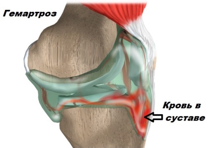 A posterior cruciate ligament sérülése és törése