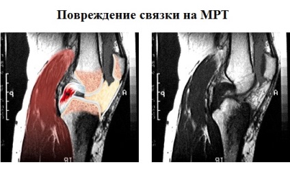 Daune și rupturi ale ligamentului posterior al crucii