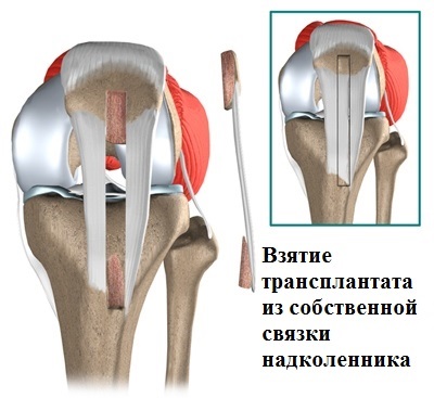 A posterior cruciate ligament sérülése és törése