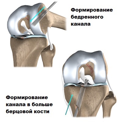 A posterior cruciate ligament sérülése és törése