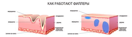 Препарати для контурної пластики, види філерів, рейтинг