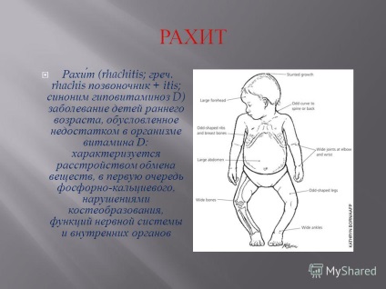 O prezentare privind diagnosticul vizual al rahitismului efectuat de 307th din қoyshymanova