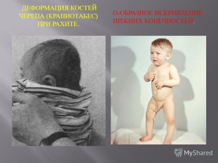 O prezentare privind diagnosticul vizual al rahitismului efectuat de 307th din қoyshymanova
