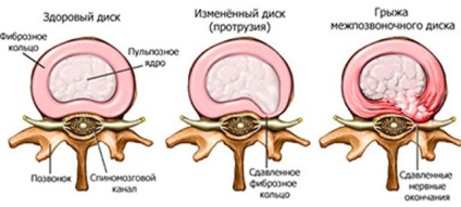 A herniated intervertebral, hasznos tudás mindenki számára