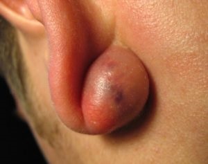 A lipoma okai, a zsír és a lipomatosis megjelenésének okai kezelésének