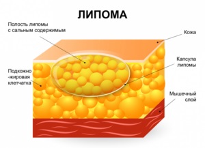 A lipoma okai, a zsír és a lipomatosis megjelenésének okai kezelésének