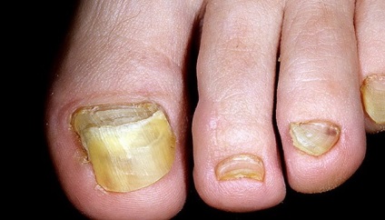 Cauze ale unghiilor galbene pe picioare și tratamentul acestora, fotografii înainte și după