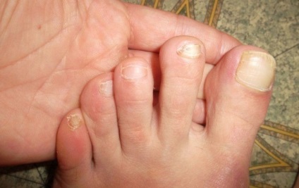 Cauze ale unghiilor galbene pe picioare și tratamentul acestora, fotografii înainte și după