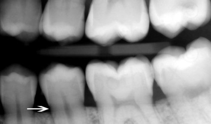 Carii de col uterin - cauze, simptome, tratamentul cariilor dentare cervicale - portal dentar