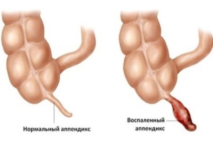 Semnele de apendicită la bărbați sunt primele simptome ale afecțiunii (cu video)