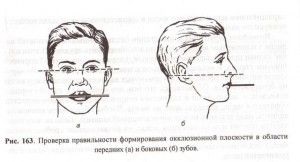 Progenic (deschis) mușcă cum să remedieze