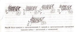 Progenic (nyitott) harapás, hogyan kell kijavítani