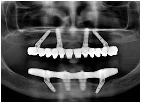 Proteze pe patru implanturi 
