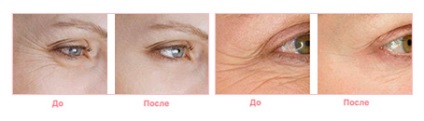 Процедури за мимическите бръчки около очите, медицински корпорация rhana