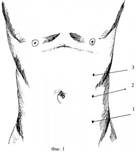 Hernia ombilicală