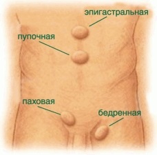 Hernia ombilicală