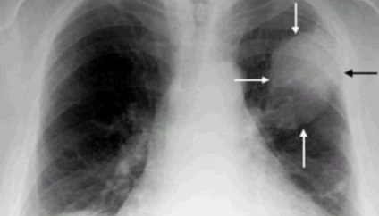 Cancerul pulmonar, dacă este posibil să se vindece